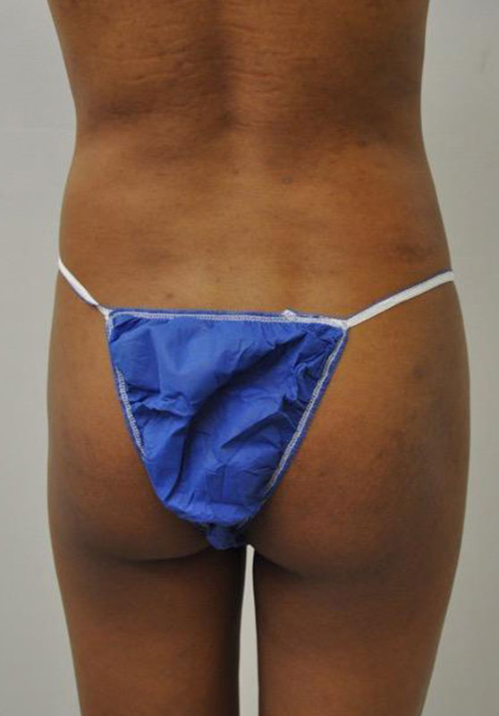 Transgender Buttocks Enhancement
