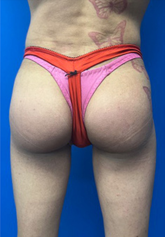 Transgender Buttocks Enhancement