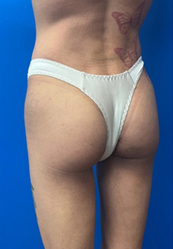 Transgender Buttocks Enhancement