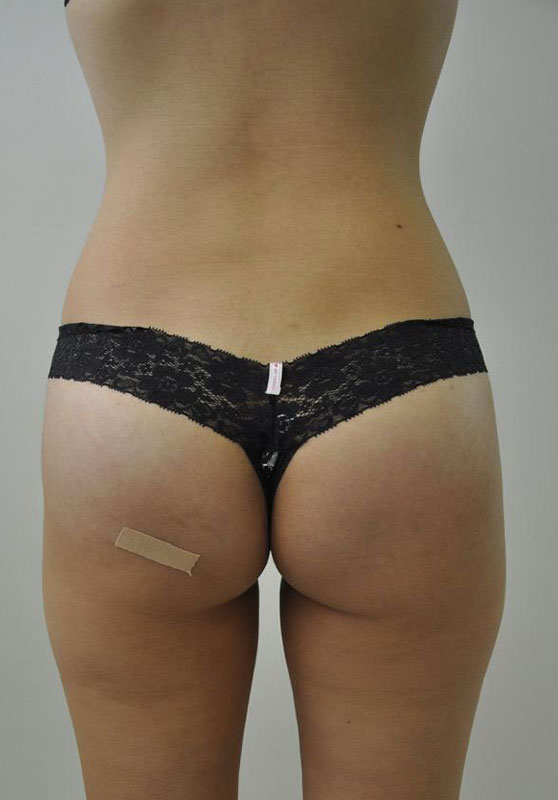 Transgender Buttocks Enhancement