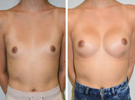 Transgender Breast Enhancement Los Angeles