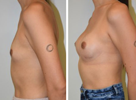 Transgender Breast Enhancement Los Angeles