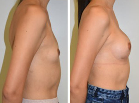 Transgender Breast Enhancement Los Angeles